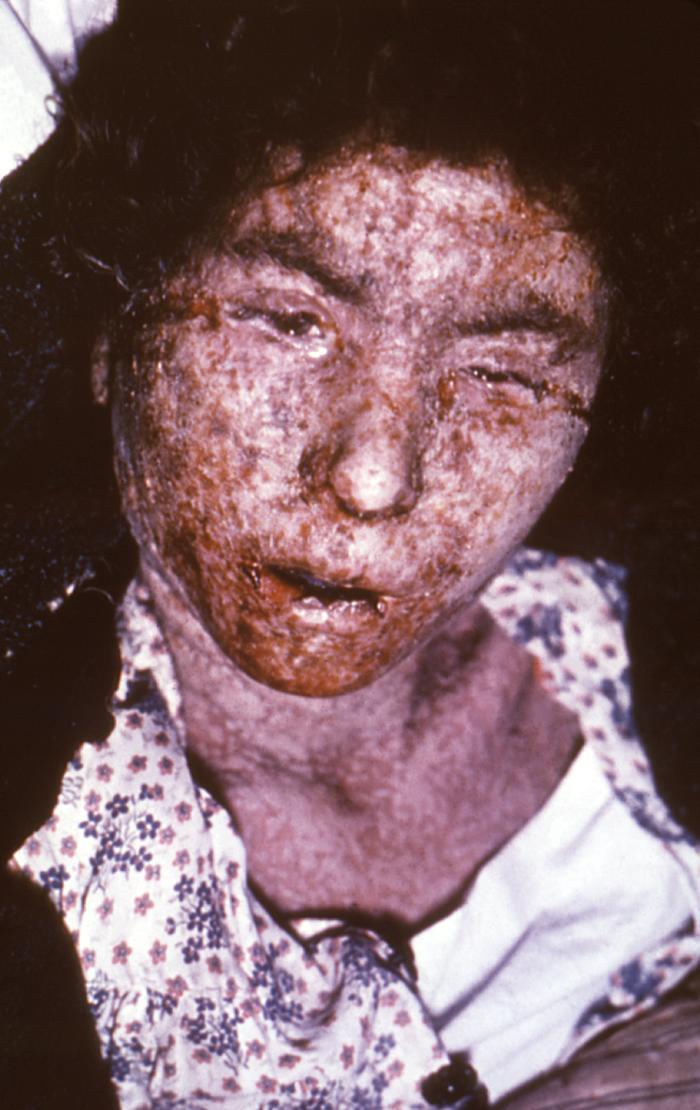Photo Gallery: Smallpox - Science
